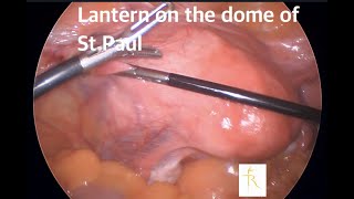 Huge Cervical fibroid : Hysterectomy