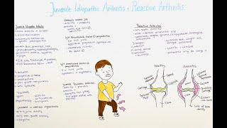 Juvenile Idiopathic Arthritis + Reactive Arthritis