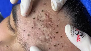 Big Cystic Acne Blackheads Extraction Blackheads \u0026 Milia, Whiteheads Removal Pimple Popping # 1618