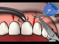 vicryl suture material