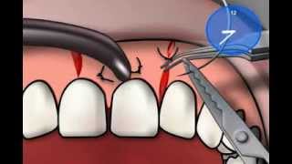 Vicryl Suture Material