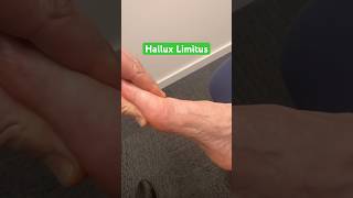 Stiff big toe? Is it Hallux Limitus ?