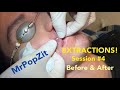 Severe Acne extractions. Session 4, amazing before and after! So many pops!