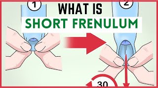 Frenulum Breve (Short frenulum): Signs & symptoms, Treatment (frenectomy of foreskin)