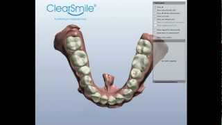 ClearSmile® Vid 3