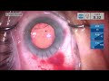 morgagnian catarock zonulopathy anterior capsule tear