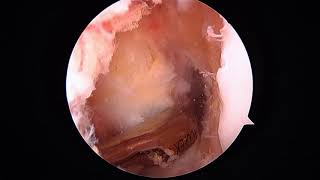 L ACL reconstruction with hamstring NR 8.19.19