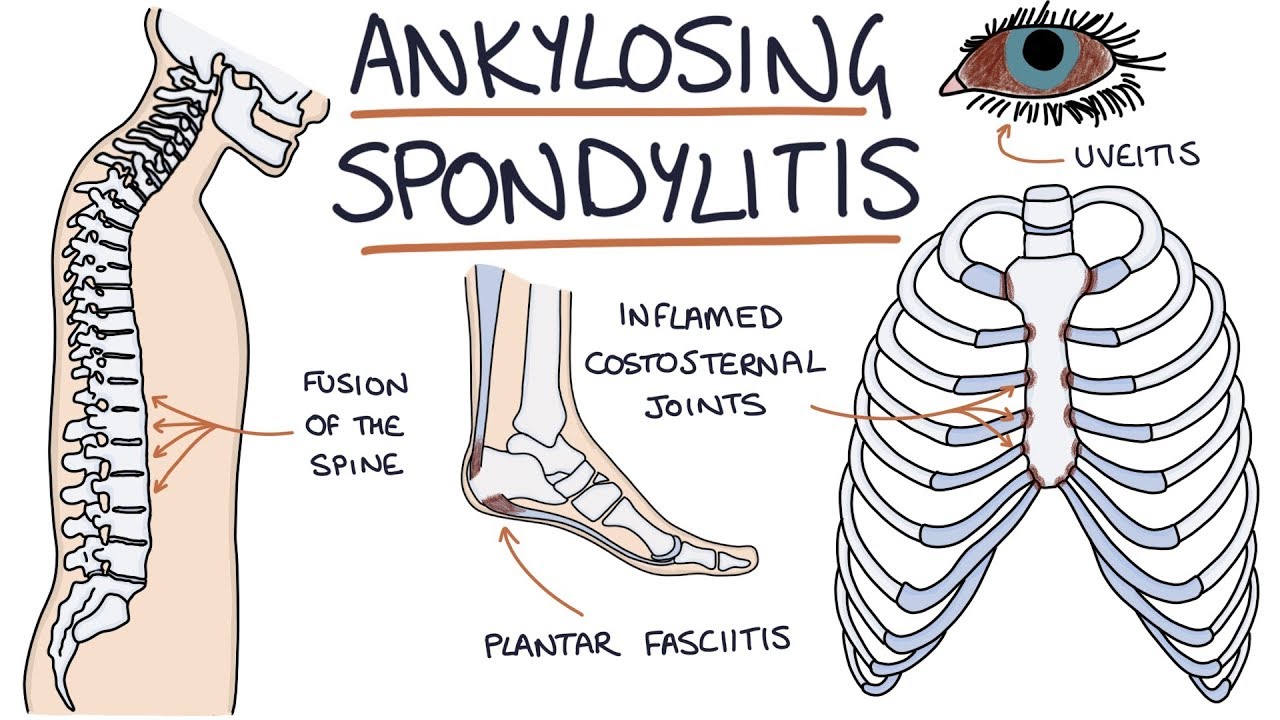 Ankylosing Spondylitis Visual Explanation For Students Youtube