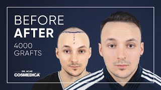 Excellent Before \u0026 After Hair Transplant with Dr. Acar