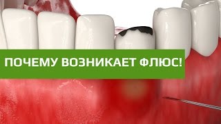 Флюс и абцесс зуба. Как возникает флюс зуба