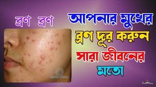 আপনার মুখের ব্রণ দূর করুন সারা জীবনের মতো | Eliminate Your Face Like a Lifetime | Doctor Shima