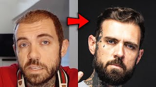 How Adam22 Reversed His Hair Loss