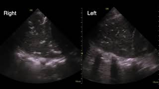 Bilateral Pneumonia Labeled Video