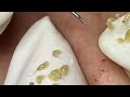 big cystic acne blackheads extraction blackheads u0026 milia whiteheads removal pimple popping 1704