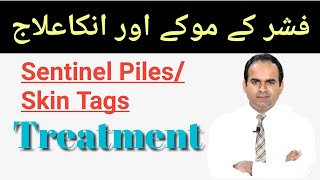Sentinel Piles/ Sentinel Skin Tags of Anal Fissure & its Treatment | Surgeon Dr Imtiaz Hussain