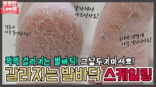 쩍~쩍~ 갈라지는 발바닥! 스케일링으로 관리하세요~ removal callus - Fresh Foot 성수점 / 남양주호평점