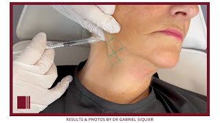 CELLBOOSTER® SHAPE double chin treatment by Dr Gabriel Siquier