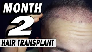 FUE Hair Transplant 2 MONTHS (post op) Istanbul, Turkey