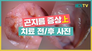 HPV 바이러스는 뿌리를 뽑아야 재발하지 않아요!(feat. 곤지름 전후사진)