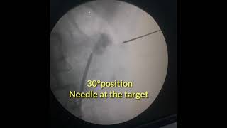 Supine PCNL : basic and principles