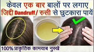 Dandruff रूसी को खत्म करने के घरेलु नुस्खे | Get Rid Of Dandruff With Easy home remedies