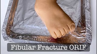 Playdough Surgery - Fibular fracture ORIF