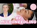 RF Microneedling Treatment FAQs - Who Doesn't Want Tight, Toned & Revitalized Skin?