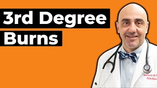 Third Degree Burn: Symptoms and Treatment