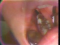 Impaction of Third Molars