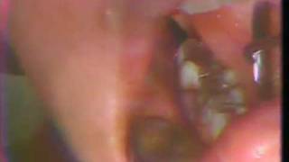 Impaction of Third Molars