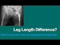 LEG LENGTH DISCREPANCY AFTER TOTAL HIP? - different leg lengths / one leg long after THA