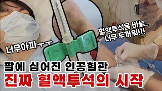 💉진짜 혈액투석의 시작! 팔로 하는 혈액투석 #신장박살 #신장암 #신장암4기 #신부전 #30대암환자 #투석 #브이로그 #투병일기