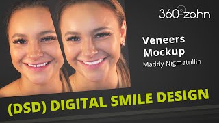 Digital Smile Design (DSD) - Veneers - Maddy Nigmatullin - Mockup - 360°zahn