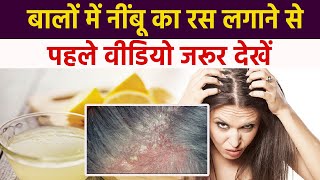 Hair में नींबू का रस लगाने पहले जरूर देखे Video, Scalp Infection से  लेकर Hair fall का खतरा| Boldsky