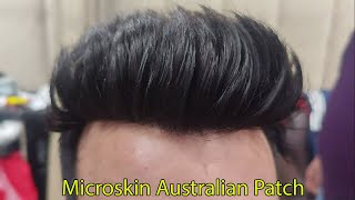 Australian Hair Patch in Delhi | Instant Baldness Solution | Natural Frontline Patch 📱 9899746489