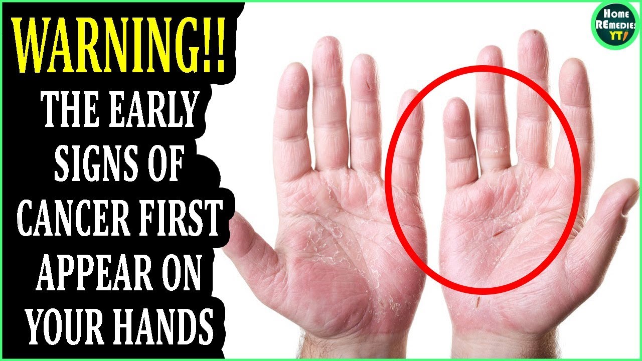 Breast Cancer Symptoms Early Signs Ilc Fact Sheet The Lobular Breast