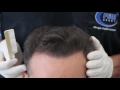 fue hair transplant 3600 grafts in nw class lv vertex by dr. juan couto fuexpert clinic spain