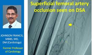 Superficial femoral artery occlusion seen on digital subtraction angiogram