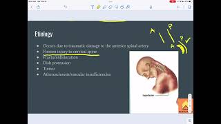 Anterior Cord Syndrome - NTPE Prep