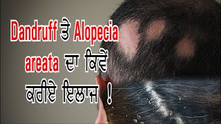 🔴LIVE🔴Dandruff ਤੇ Alopecia areata ਦਾ ਕਿਵੇਂ ਕਰੀਏ ਇਲਾਜ ! || Hamdard Health Talk