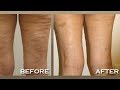 how to get rid of loose skin on legs after weight loss