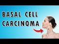 Basal Cell Carcinoma