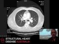 ECMO for massive pulmonary embolism - Prof Paul Forrest