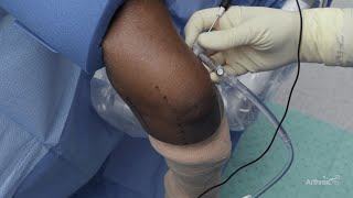 Elbow Arthroscopy Using the NanoNeedle Scope System