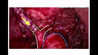 Laparoscopic cholecystectomy explained