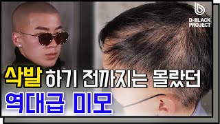 탈모약으로 머리 더 빠지고, 두피문신으로 인물 폈다!