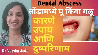 दात/हिरड्यातुन पू येणे| तोंडामध्ये पू होणे: कारणे आणि उपाय| Dental abscess|Types of dental abscess