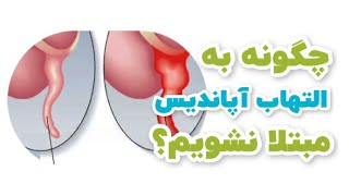 چگونه به التهاب آپاندیس مبتلا نشویم؟/دکترنکته