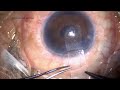 descemet s stripping automated endothelial keratoplasty dsaek in pbk dr. chirag mittal