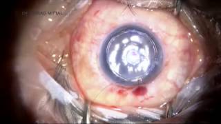 Descemet's Stripping Automated Endothelial Keratoplasty (DSAEK) in PBK - Dr. Chirag Mittal